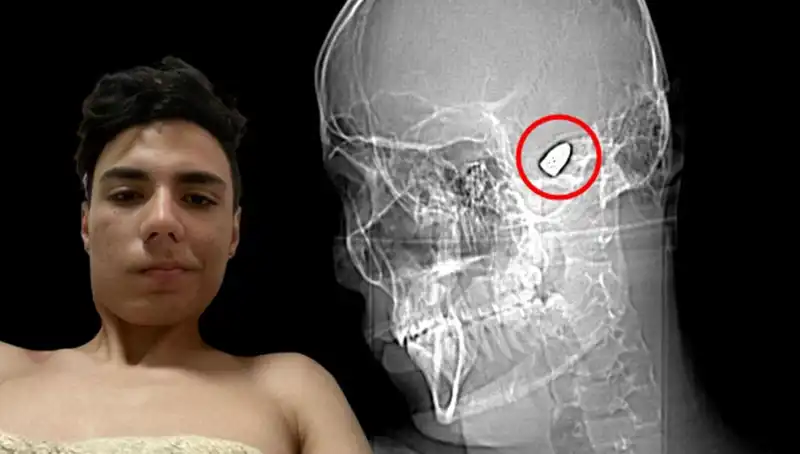 Kafasında Patlayıcı Bomba Taşıyan Adamın Hikayesi